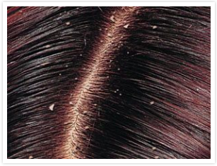 Vervagen Trechter webspin Ban Hoofdhuidproblemen | Haarwerkstudio Zijlstra