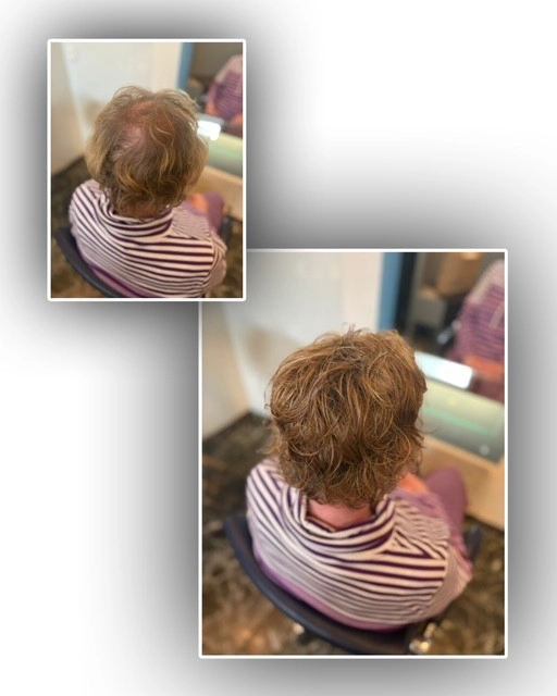 pruiken-limburg-resultaat-voor-en-na-img-108