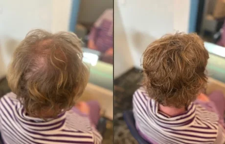 pruiken-limburg-resultaat-voor-en-na-img-145